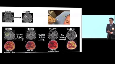 behnam badie|City of Hope Seeks to Advance Glioblastoma Treatment Through .